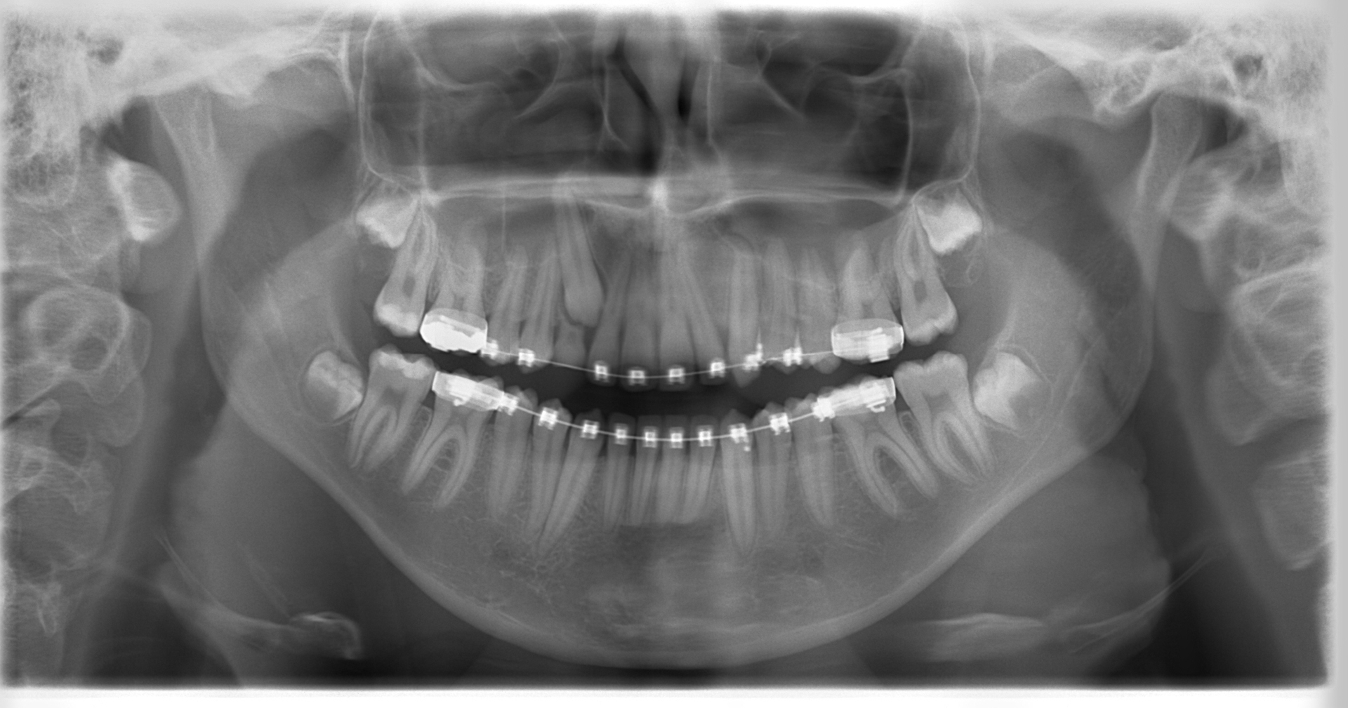 Morita 2dcp Ortodonti Röntgen