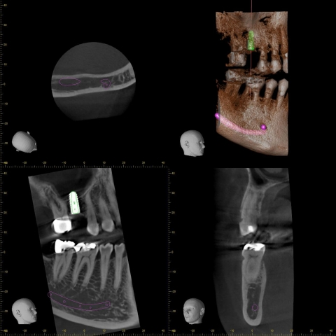 Veraviewepocs 3D Röntgen Üzerinde İmplant