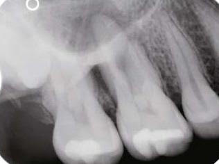 Dental Tomografi