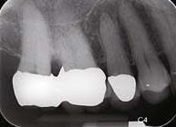Dental Radyoloji Cihazları - Periapikal çekim