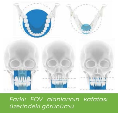 Volumetrik Tomografi - Farklı FOV alanlarının kafatası üzerindeki görünümü