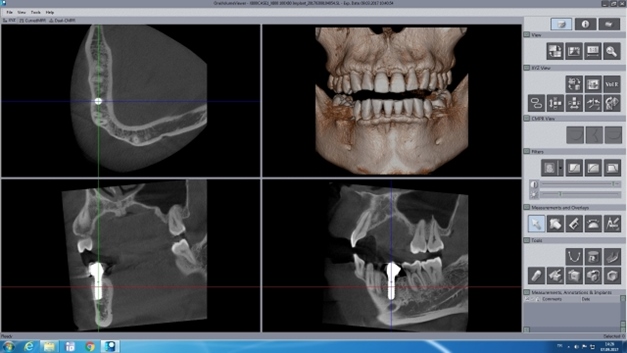 Koni Işınlı Bilgisayarlı Tomografi ile Implant Uygulaması