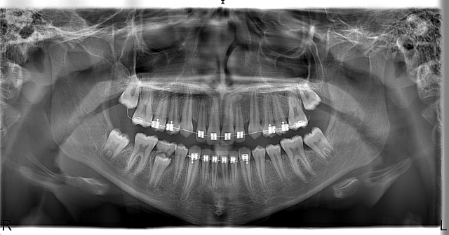 Diş Röntgeni Nedir? Kaç Çeşit Diş Röntgeni Çekilir?
