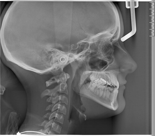 Diş Röntgeni Nedir? Kaç Çeşit Diş Röntgeni Çekilir?