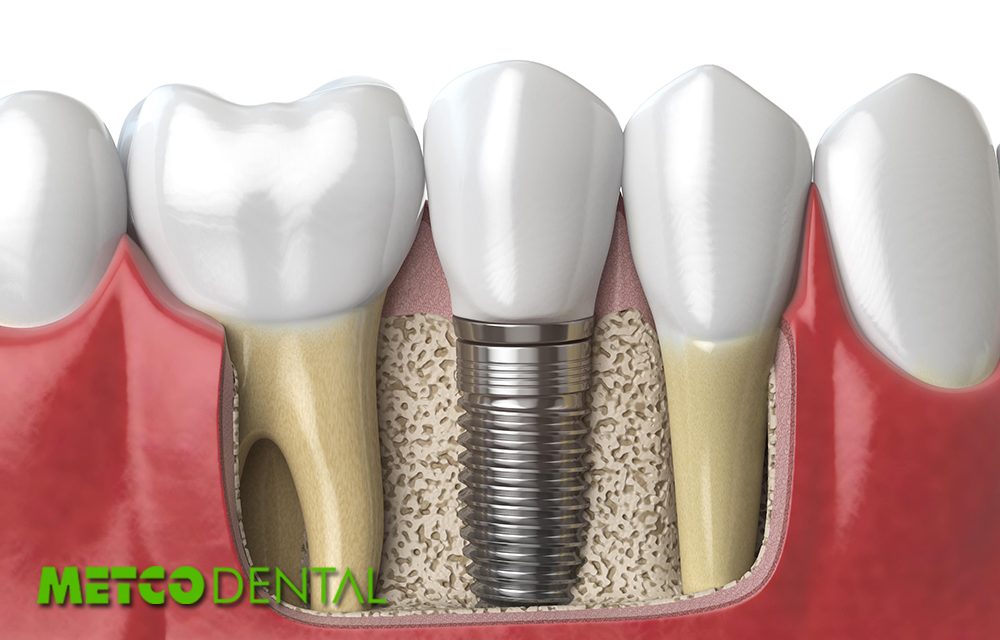 https://metcodental.com/wp-content/uploads/2020/09/Dental-Implantların-Avantajları-ve-Dezavantajları-Nelerdir-1000x640.jpg