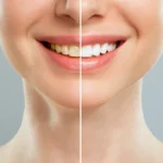 Diş Beyazlatma Nedir (Bleaching)