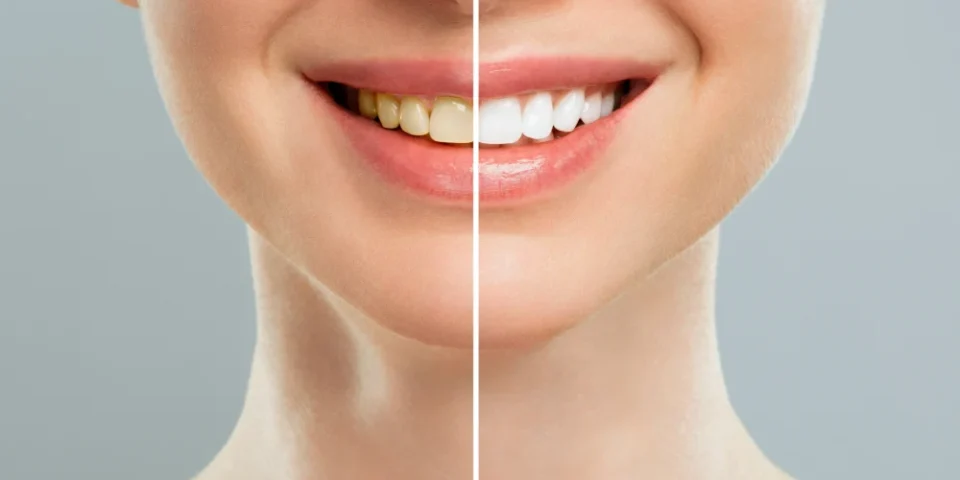 Diş Beyazlatma Nedir (Bleaching)