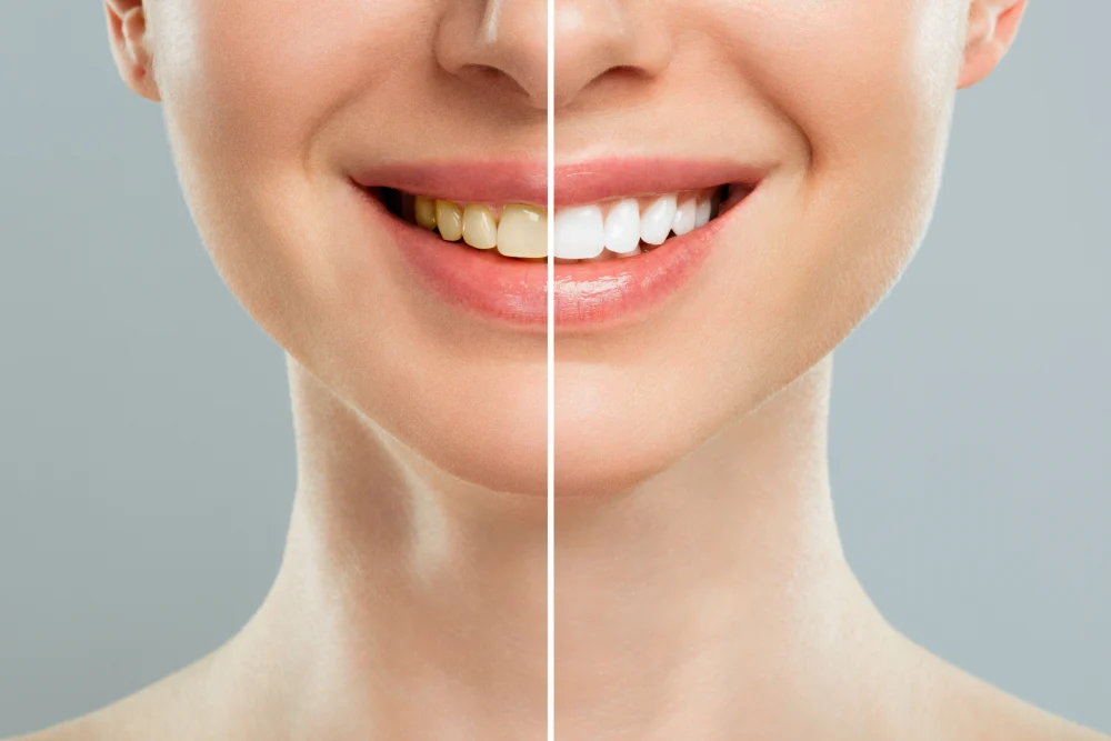 Diş Beyazlatma Nedir (Bleaching)