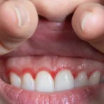 Gingivitis (Diş Eti İltihabı) Nedir