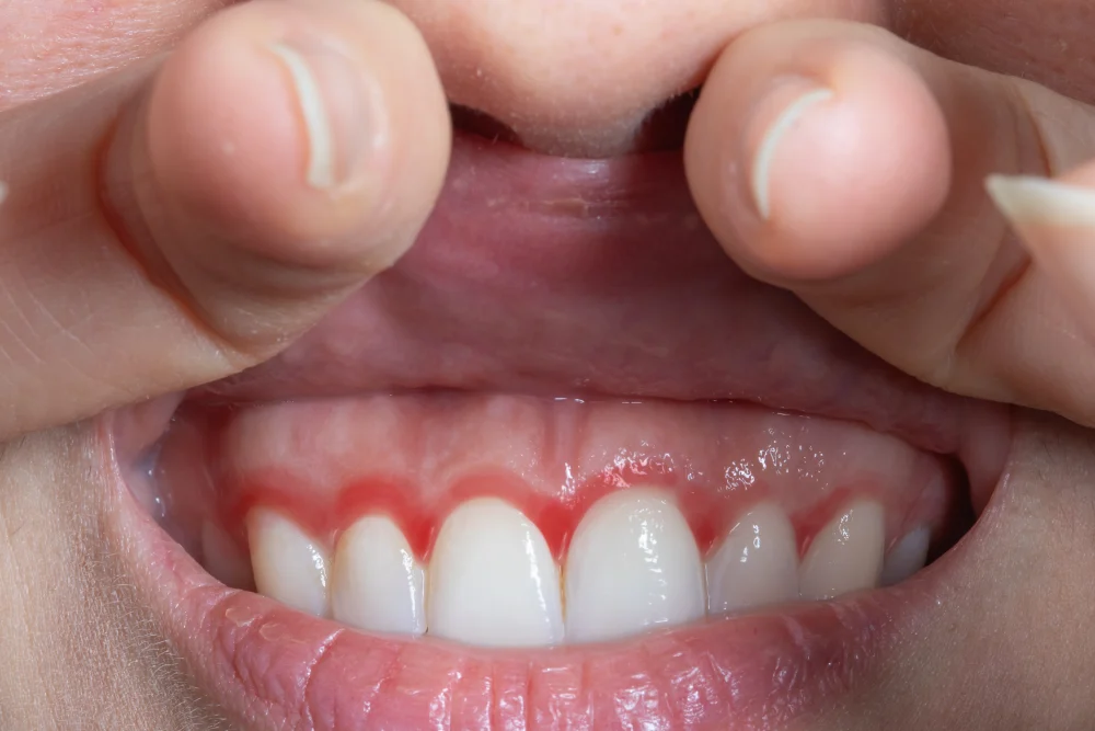 Gingivitis (Diş Eti İltihabı) Nedir