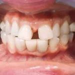 Ayrık Diş Nedir Diastema Nedir