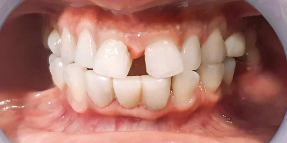 Ayrık Diş Nedir Diastema Nedir