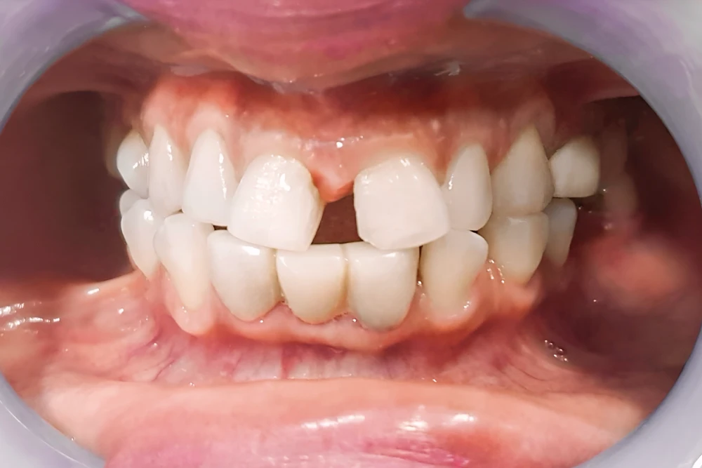 Ayrık Diş Nedir Diastema Nedir