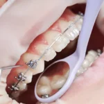 endodonti nedir