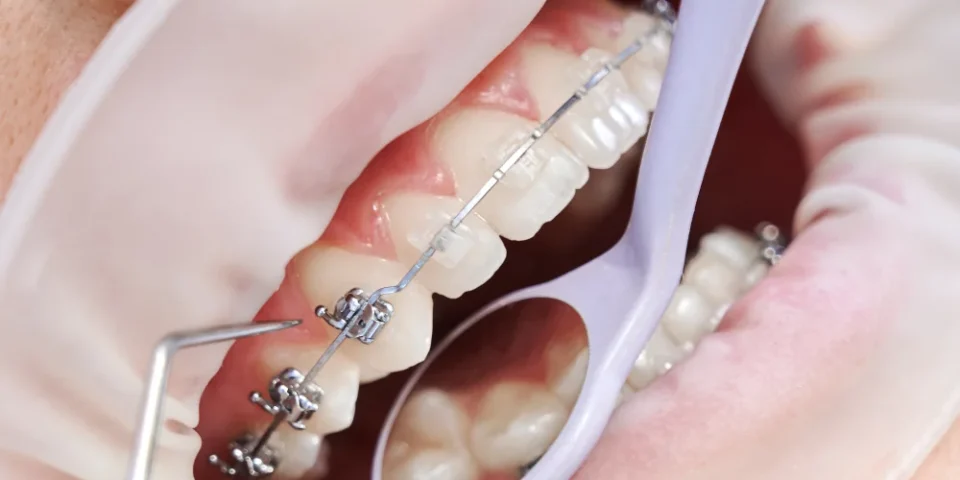 endodonti nedir