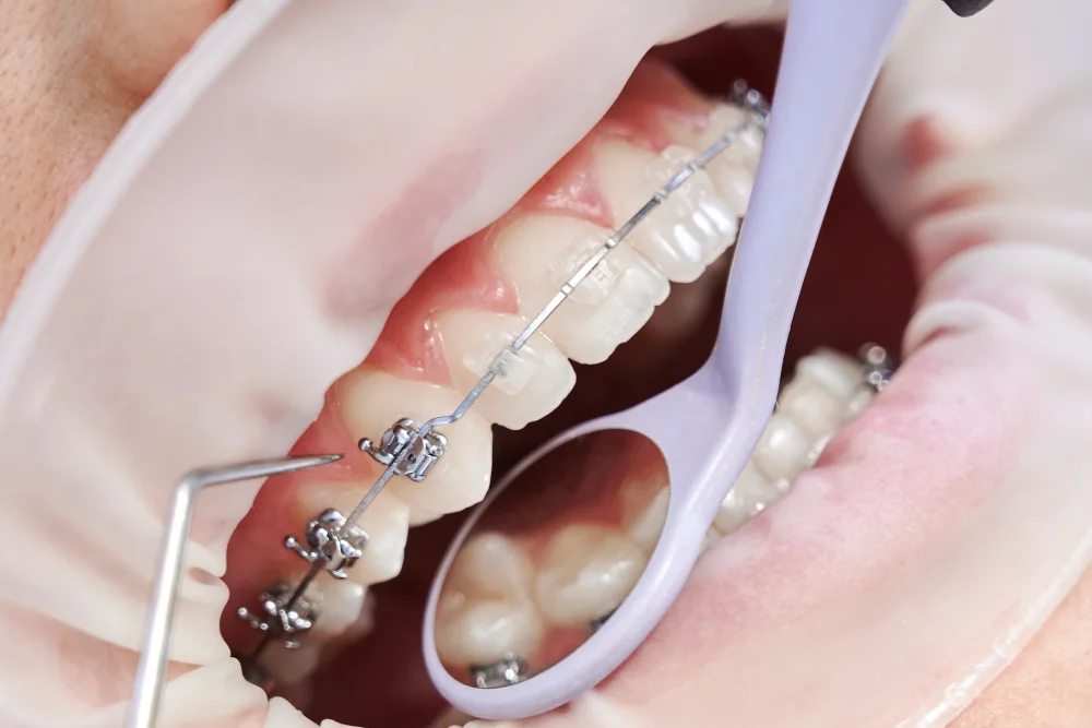 endodonti nedir