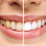 Bleaching Diş Beyazlatma Nedir Yan Etkileri ve Süreç