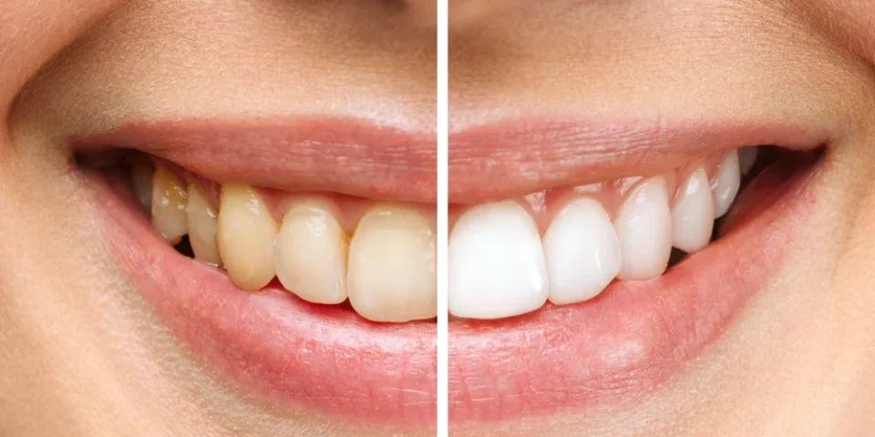 Bleaching Diş Beyazlatma Nedir Yan Etkileri ve Süreç