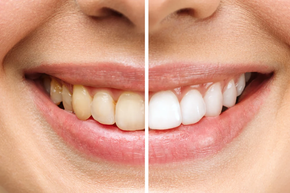 Bleaching Diş Beyazlatma Nedir Yan Etkileri ve Süreç