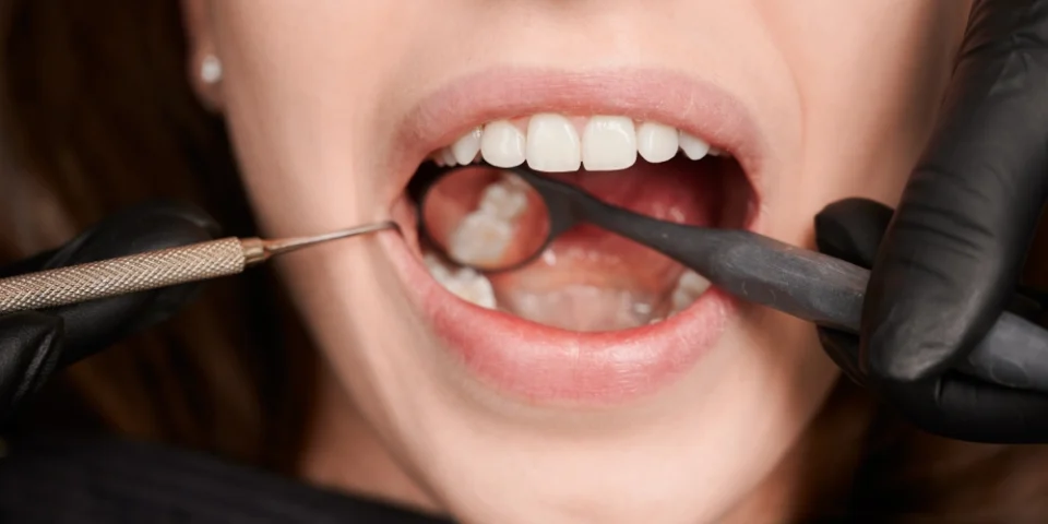 Diş Eti Kanaması Hangi Vitamin Eksikliğinden Kaynaklanır